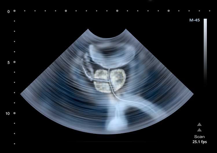 Ultraschall einer Prostata. Akute Probleme können mit ACTICORE behandelt werden